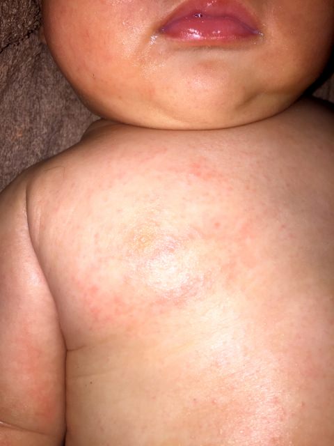 赤ちゃん　汗疹