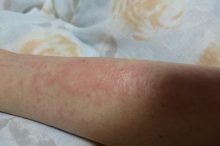 紫外線アレルギー　症状